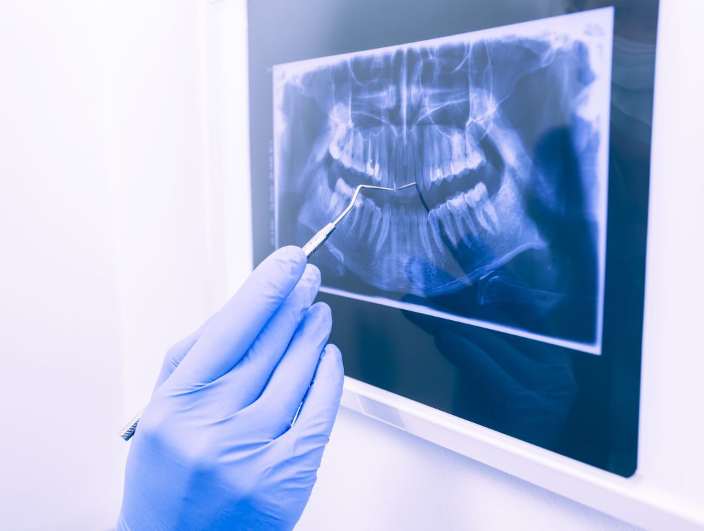 How safe and necessary are dental X-rays?